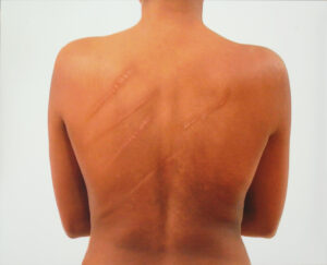 The back of a medium skin toned woman occupies the center of the photograph. Long, diagonal scars stretch across the top of her back.